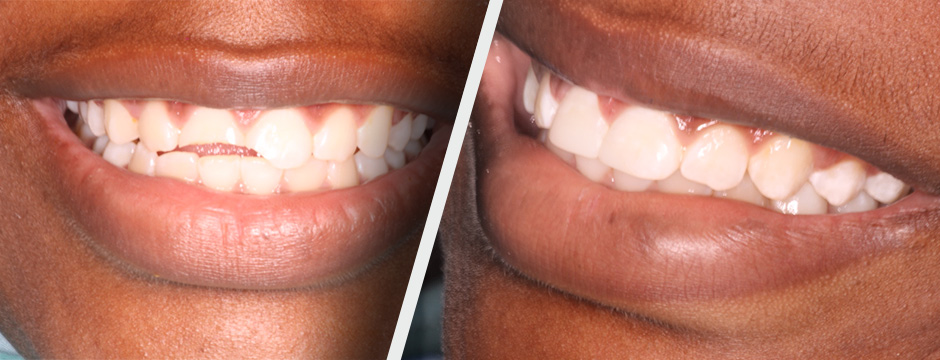 Before and After Orthodontics